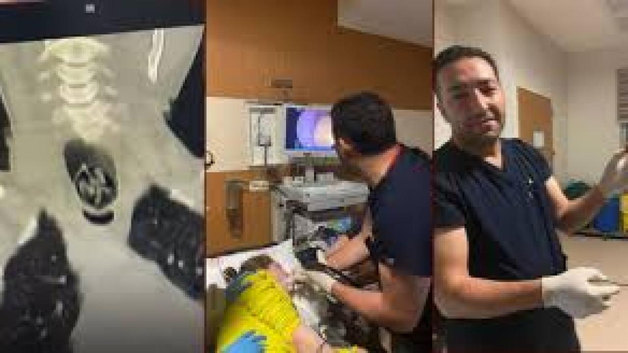 Yuttuğu ceviz yemek borusundan çıkarıldı