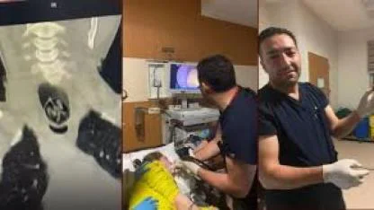 Yuttuğu ceviz yemek borusundan çıkarıldı